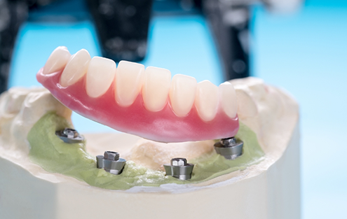 Model of an implant denture on a desk