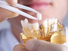 dentist placing a crown on a dental implant in a model of a mouth