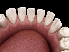 Illustration of gaps between teeth in lower arch