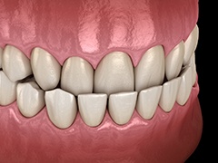 Illustration depicting a close-up of an underbite