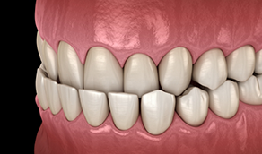 Illustrated mouth with underbite
