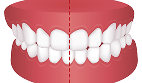 Illustrated mouth with crossbite
