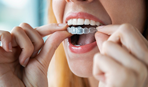 Blonde woman placing Invisalign over her teeth