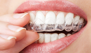 Close up of a person placing an Invisalign aligner over their teeth