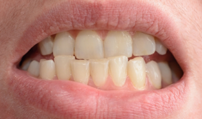 Close up of a mouth with crowded teeth