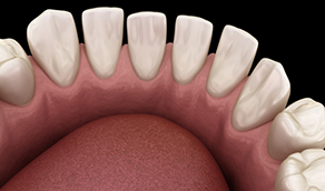 Illustration of a lower arch of gapped teeth