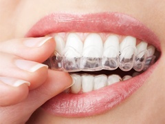 A woman putting in an Invisalign aligner
