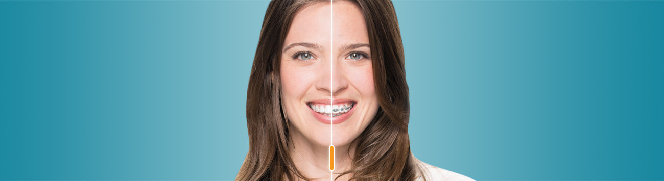 Woman smiling with traditional braces and Invisalign