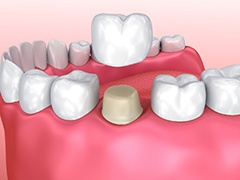 Metal-free restoration in Torrance, CA being placed on tooth