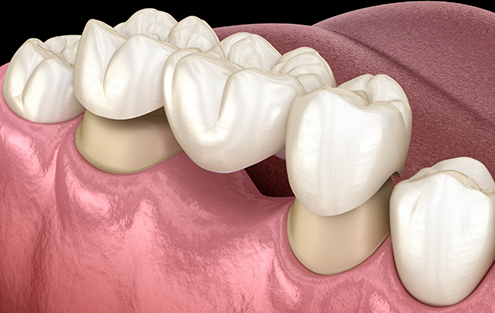 Illustrated dental bridge filling the empty space of a missing tooth