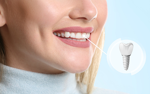 Close up of a woman smiling with a dental implant