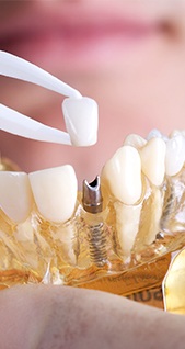 Model of implant dental crown