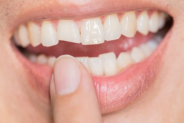 smile with chipped front tooth close up