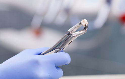 Forceps holding an extracted tooth