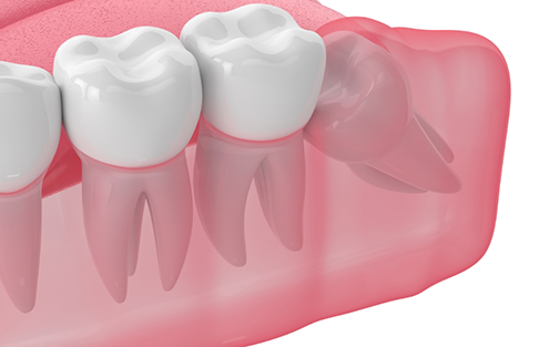 Illustration of an impacted wisdom tooth pressing against another tooth