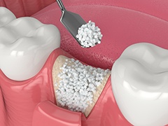 Illustration of granulated bone material being placed into tooth socket