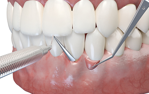 Illustrated of gum tissue graft being performed