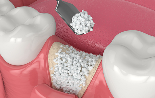 Illustrated bone grafting material being placed into empty space after tooth extraction