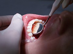 Closeup of patient during scaling and root planing periodontal therapy