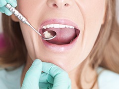 Closeup of patient during dental exam after tooth colored filling
