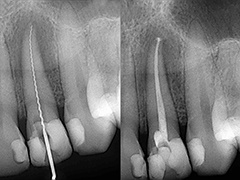 X-rays of root canal treated teeth