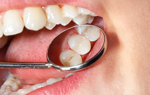Dental mirror inside of a mouth