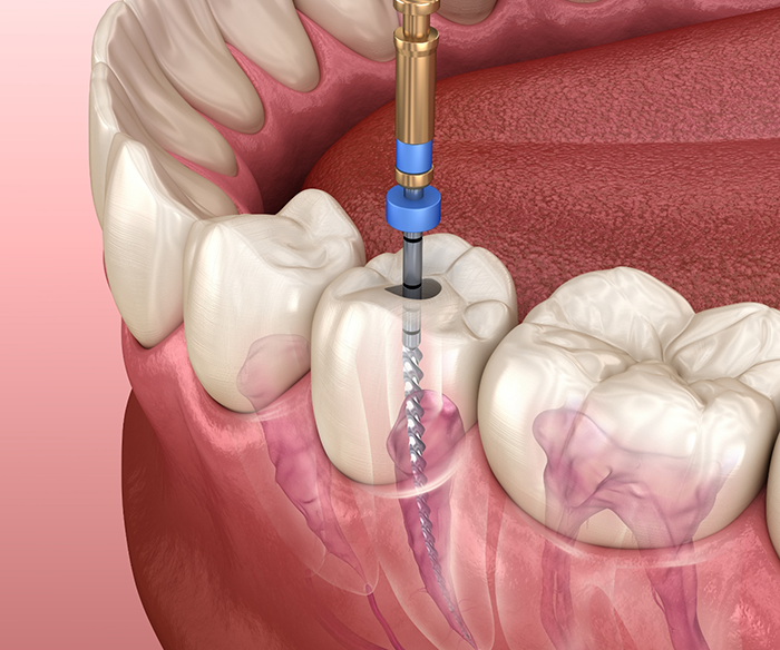 Illustration of dental instrument treating the inner layer of a tooth during root canal treatment