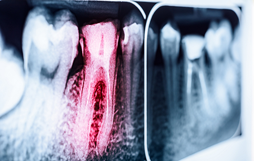 X ray of an infected tooth needing root canal treatment