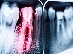 X-ray of root canal treated tooth highlighted red