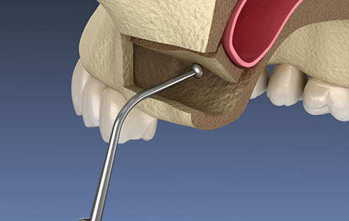 Illustration of a dental instrument performing a sinus lift