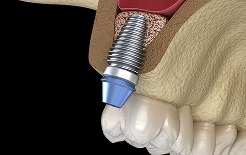 Illustrated dental implant in the upper jaw