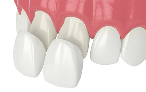 Illustration of veneers being placed over teeth