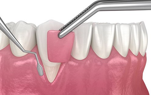 Illustration of gum graft being placed on exposed tooth root