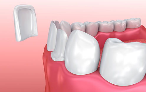 Illustrated veneer being placed over the front of a tooth
