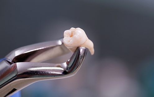 Clasp holding an extracted tooth