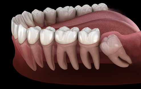 Illustrated impacted wisdom tooth pressing against adjacent tooth