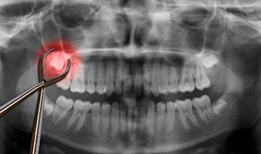 Illustration of teeth with wisdom tooth highlighted red