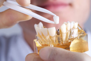 Dental implants in Torrance last indefinitely.