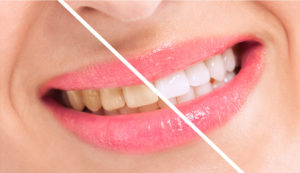 Teeth whitening in Torrance removes years of stains