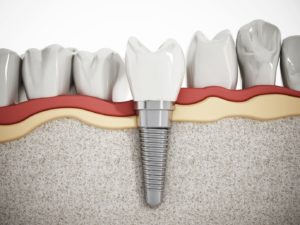 Representation of dental implants
