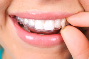 woman smiling Invisalign