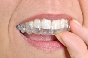 person inserting invisalign tray