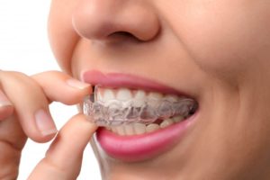 A woman removing her clear aligner.