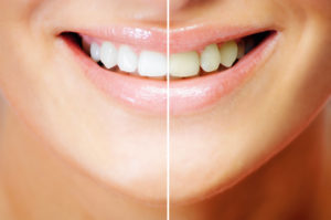 Teeth whitening, before and after