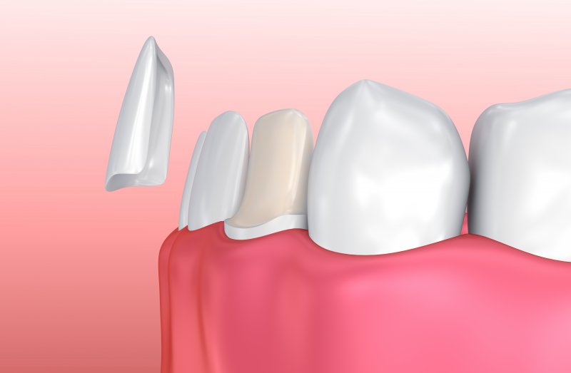 porcelain veneers