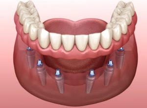 implant-retained dentures 