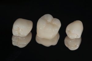 dental crowns in Torrance