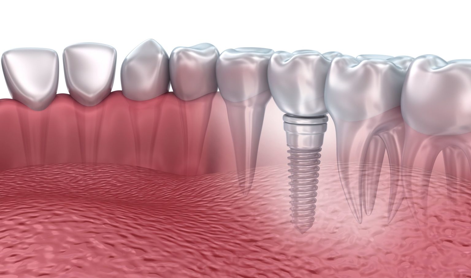 Dental Implants in Torrance Dental Implant Process