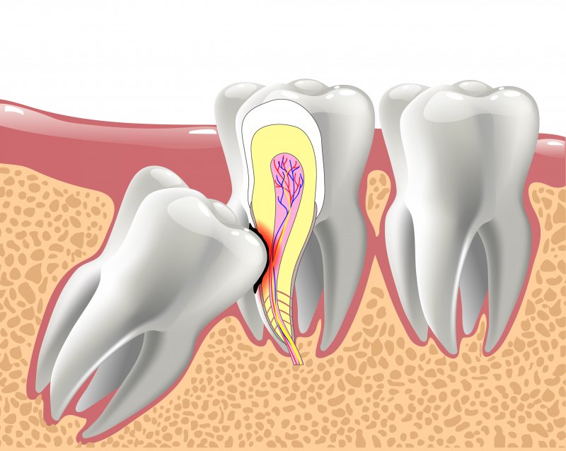 Signs Of An Impacted Wisdom Tooth L Blue Coast Dental Group