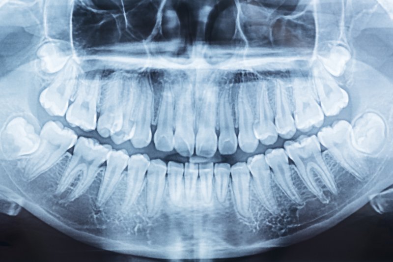 dental X-ray showing impacted wisdom teeth